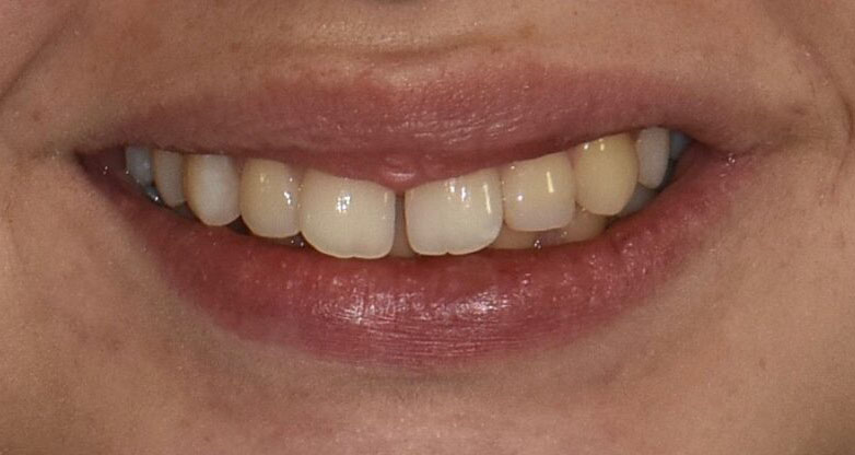 Trattamento ortodontico multibrackets