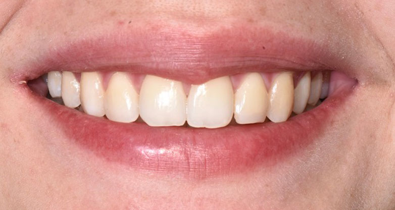 Trattamento ortodontico multibrackets