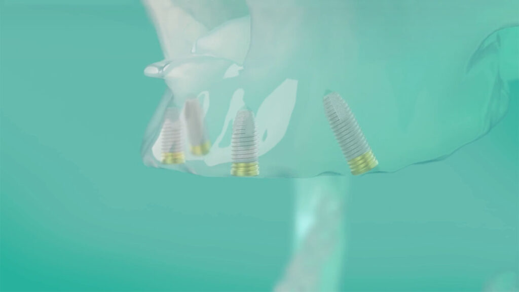 implantologia dentale