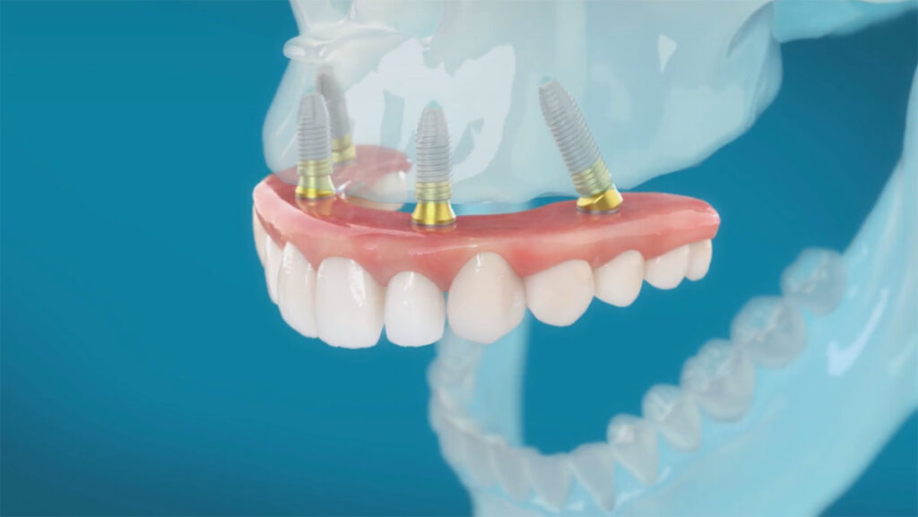 implantologia dentale