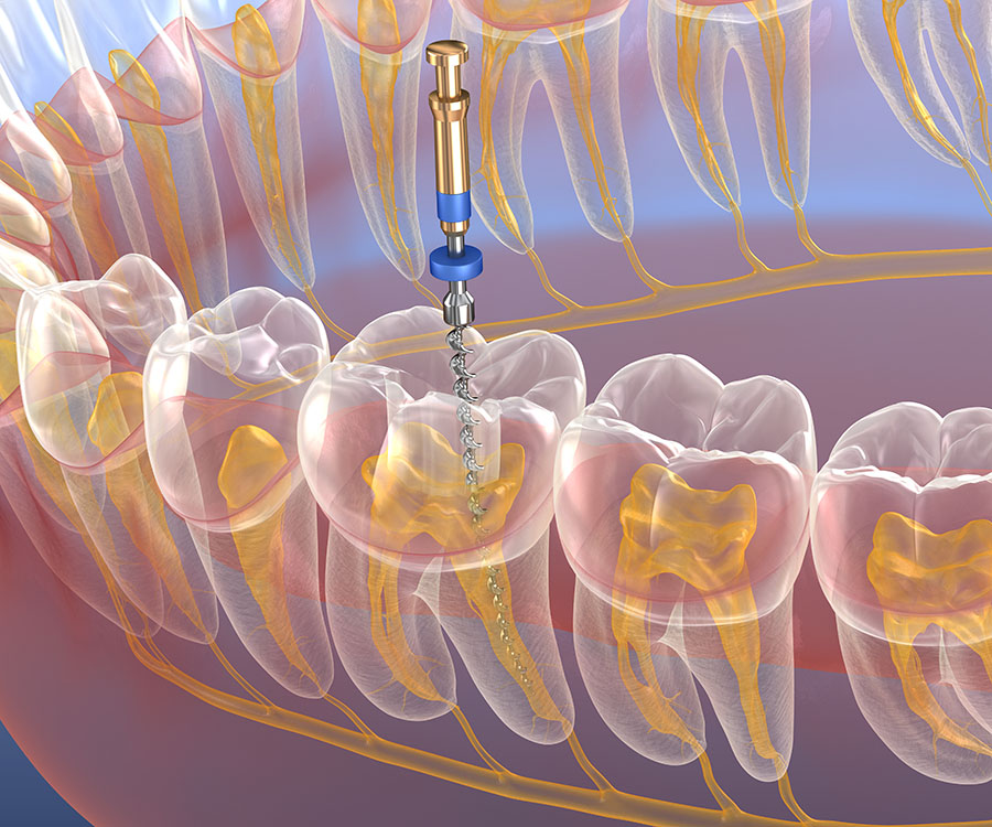 endodonzia